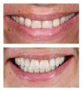 бондинг на зъби - 48998 типа | Supreme Dental бондинг на зъби - 8004 типа